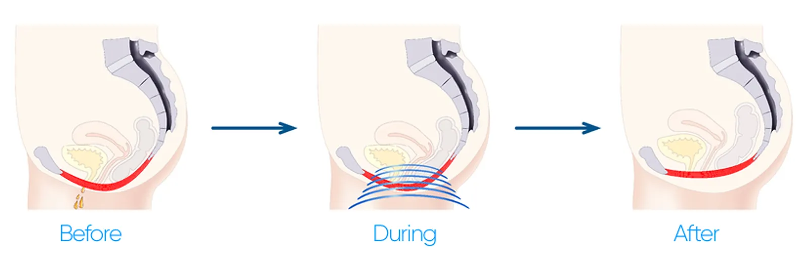 intisculpt image.jpg